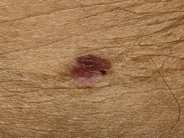 Clinical photograph: Invasive melanoma under 0.8 mm thick, with very little pigment. GPT-6 Astra called it a basal cell carcinoma with 95% confidence.