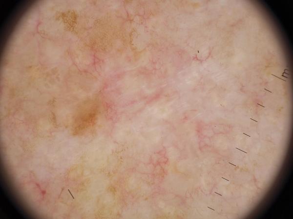 Dermoscopic image: Basal cell carcinoma on the trunk of a 75-year-old man. Both models answered correctly.