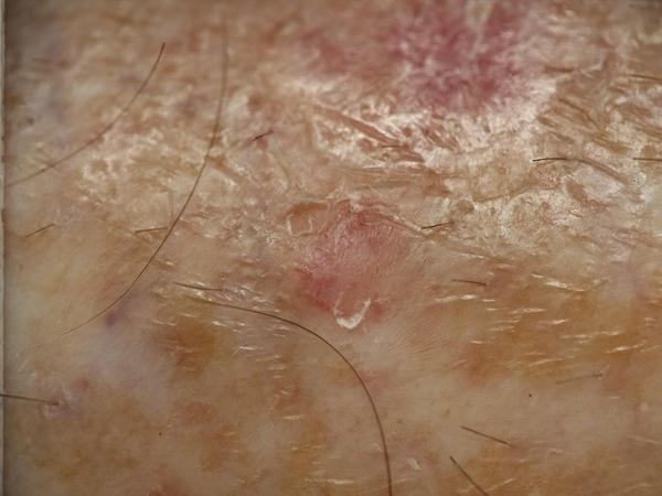 Clinical photograph: Seborrhoeic keratosis on the leg. Both models called it an actinic keratosis and said it should not be discharged.