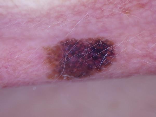Dermoscopic image: Invasive melanoma on the ear, under 0.8 mm thick.