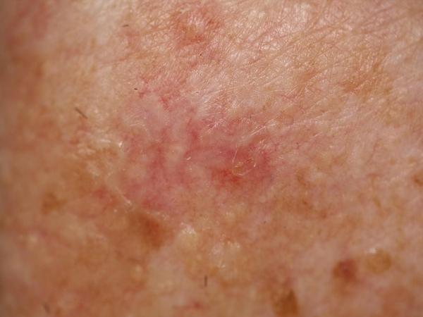 Clinical photograph: Basal cell carcinoma on the trunk of a 75-year-old man. Both models answered correctly.
