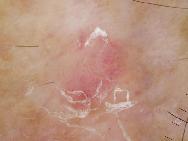 Dermoscopic image: Seborrhoeic keratosis on the leg. Both models called it an actinic keratosis and said it should not be discharged.