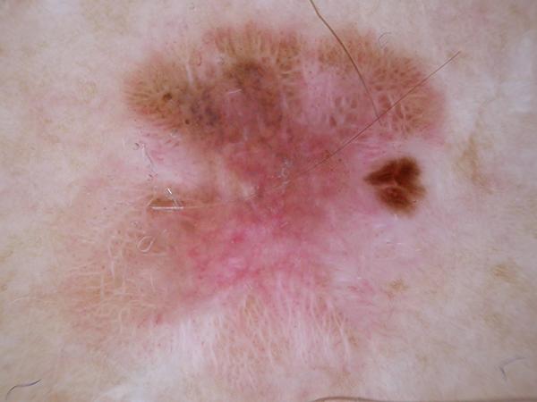 Dermoscopic image: Invasive melanoma under 0.8 mm thick, with very little pigment. GPT-6 Astra called it a basal cell carcinoma with 95% confidence.