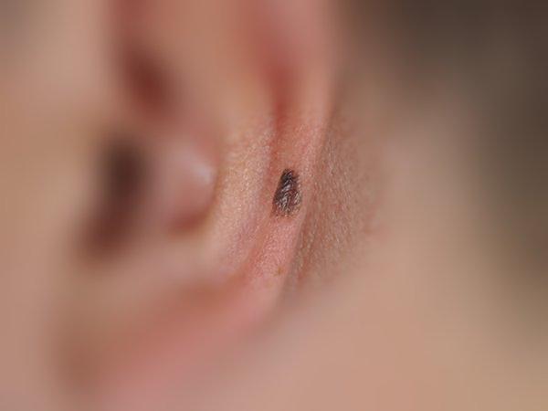 Clinical photograph: Invasive melanoma on the ear, under 0.8 mm thick.